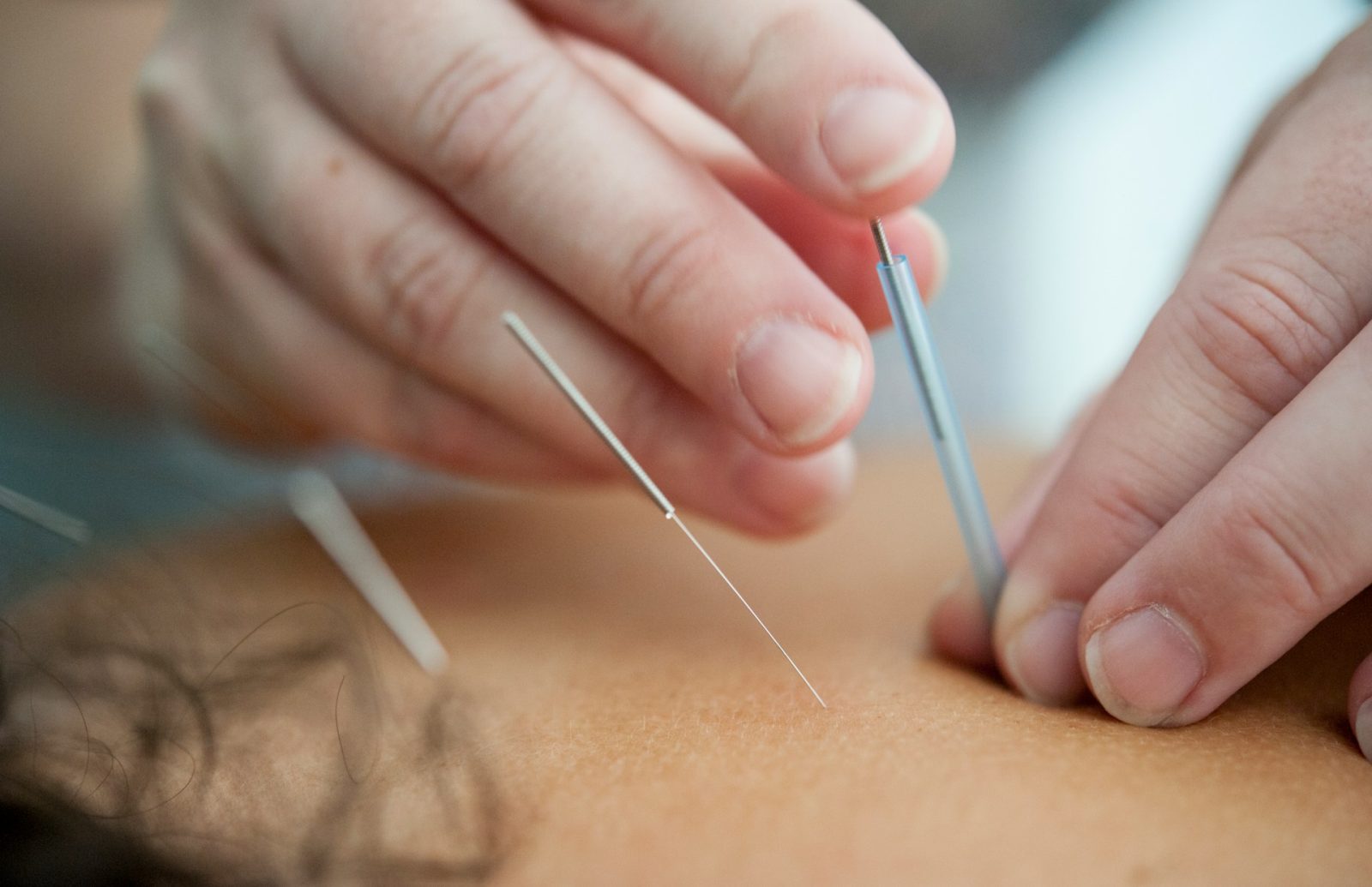 Acupuncturist in Portland