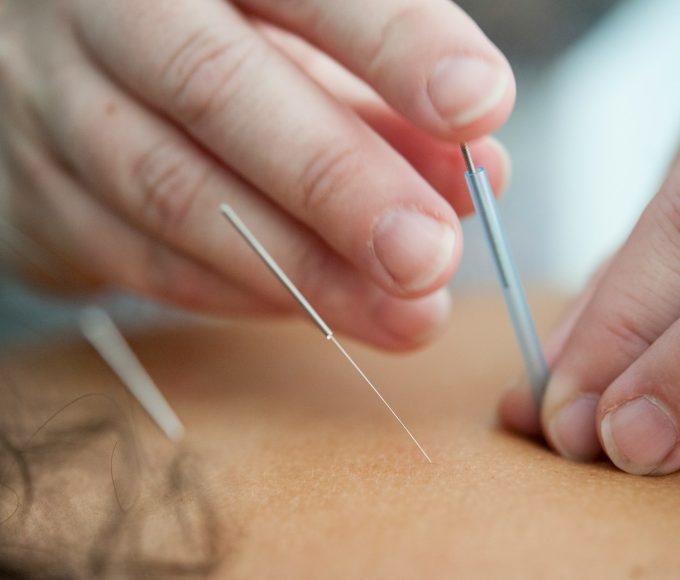 Acupuncturist in Portland